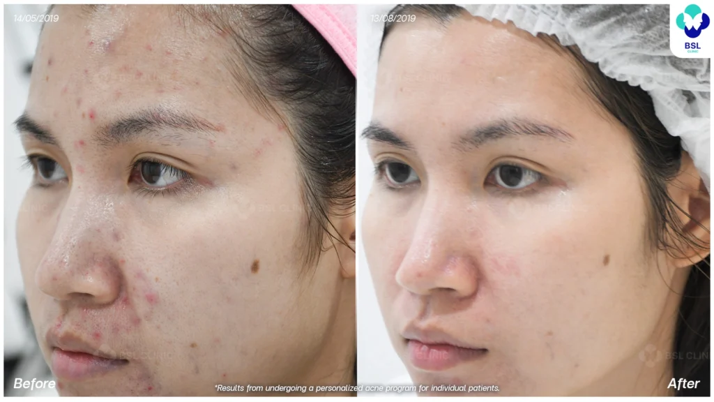 รีวิวรักษาสิว มั่นใจขึ้น