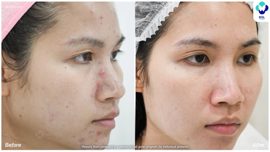 รีวิวรักษาสิว มั่นใจขึ้น