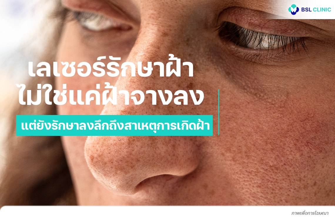 เลเซอร์รักษาฝ้า ไม่ใช่แค่ฝ้าจางลง แต่ยังรักษาลงลึกถึงสาเหตุการเกิดฝ้า