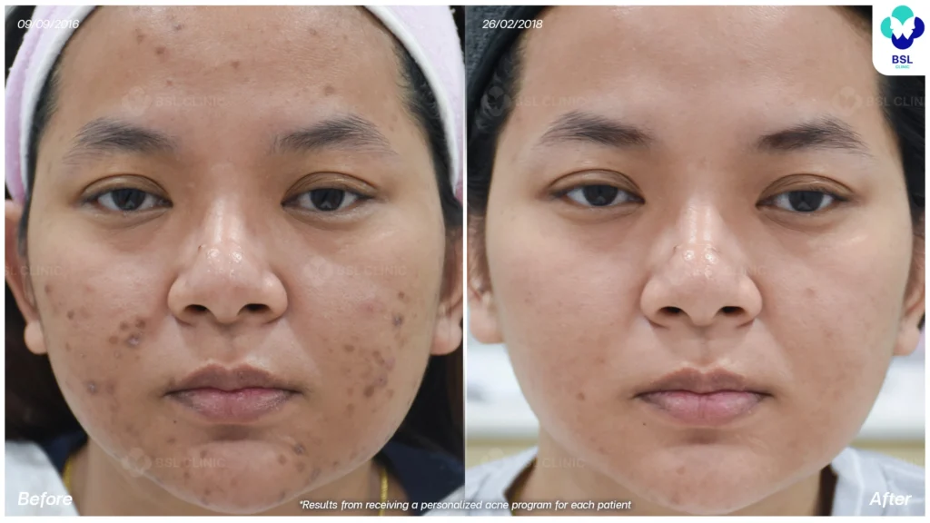 รีวิวรักษาสิว bsl clinic