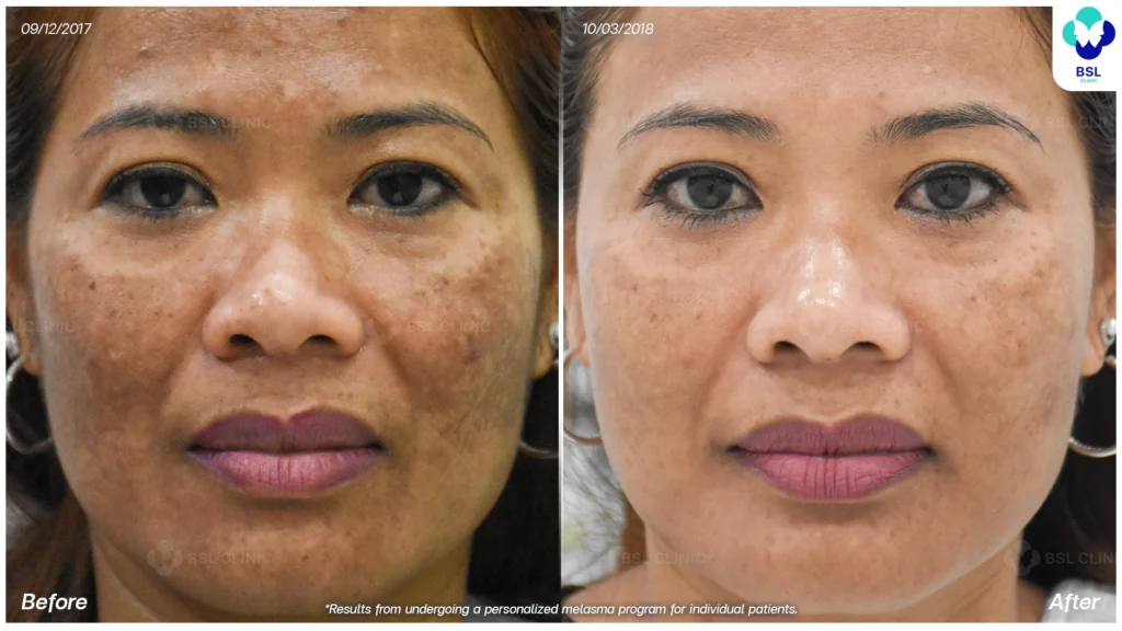 รีวิวรักษาฝ้า