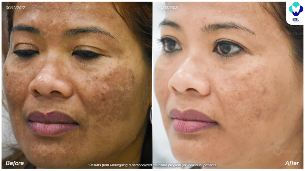 รีวิวรักษาฝ้า