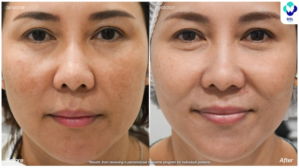 รีวิวรักษาฝ้า