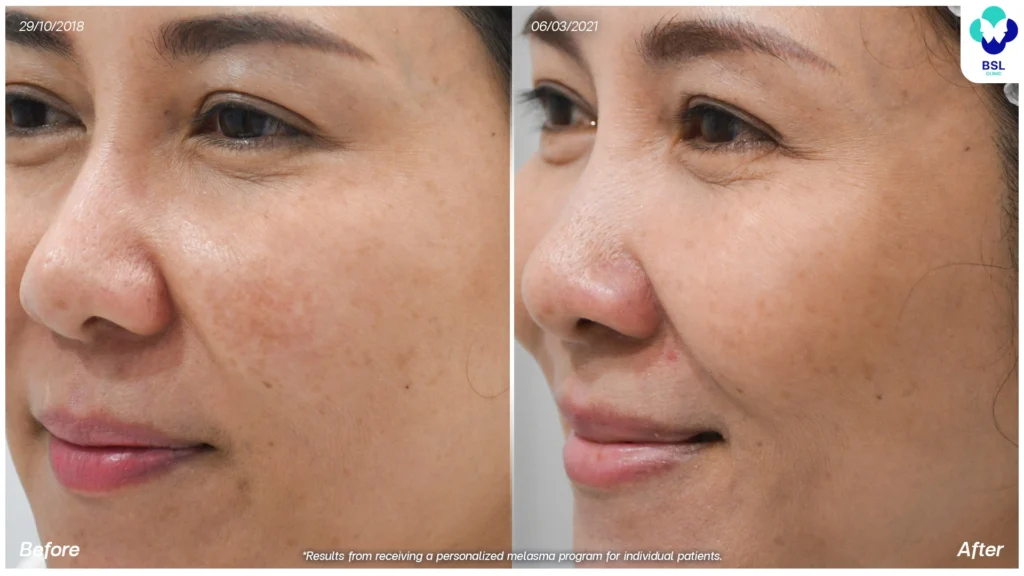 รีวิวรักษาฝ้า