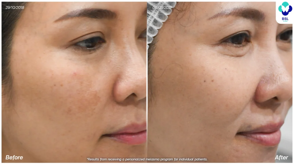 รีวิวรักษาฝ้า