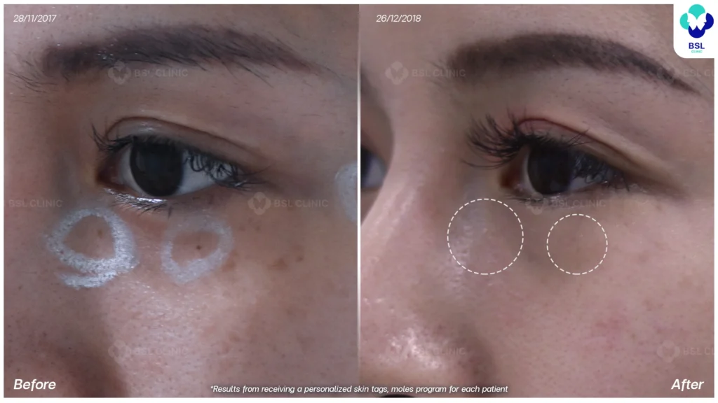 เลเซอร์ขี้แมลงวัน ไฝ กระเนื้อ