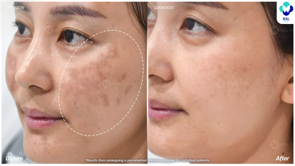 รีวิวรักษาฝ้า