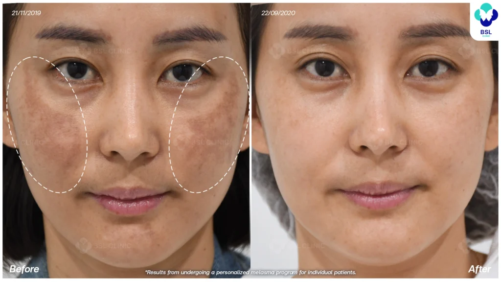 รีวิวรักษาฝ้า