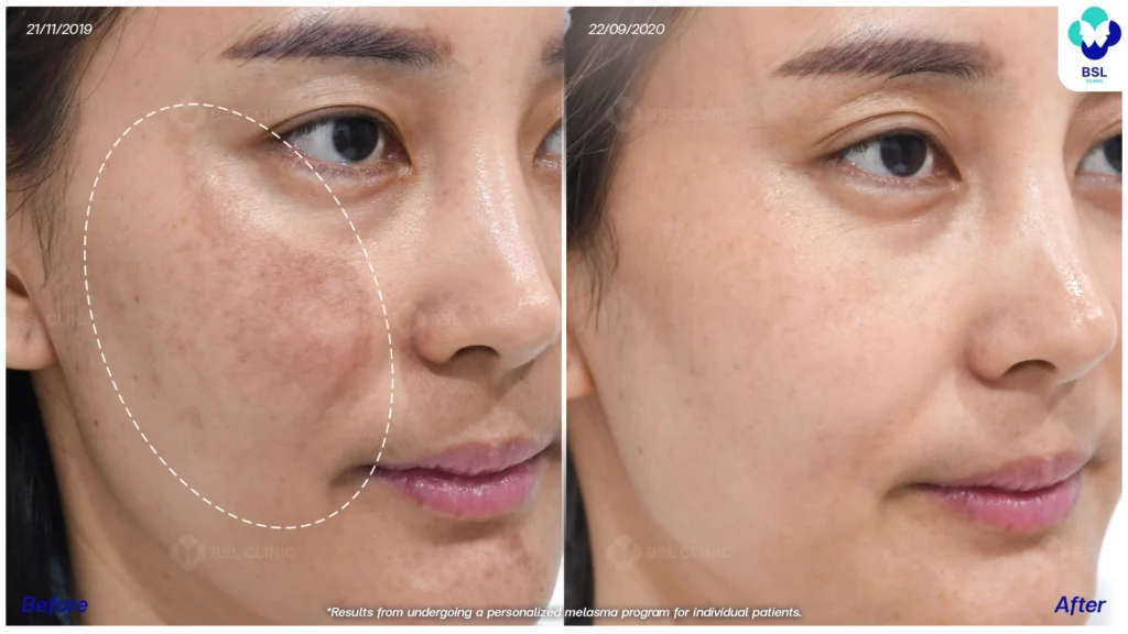 รีวิวรักษาฝ้า