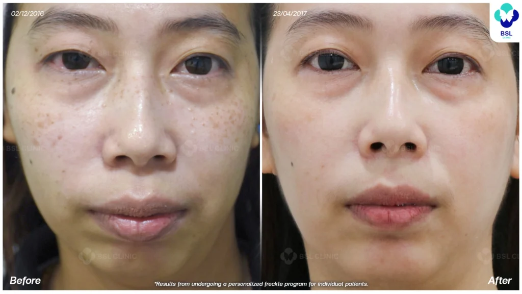 รีวิวรักษากระ