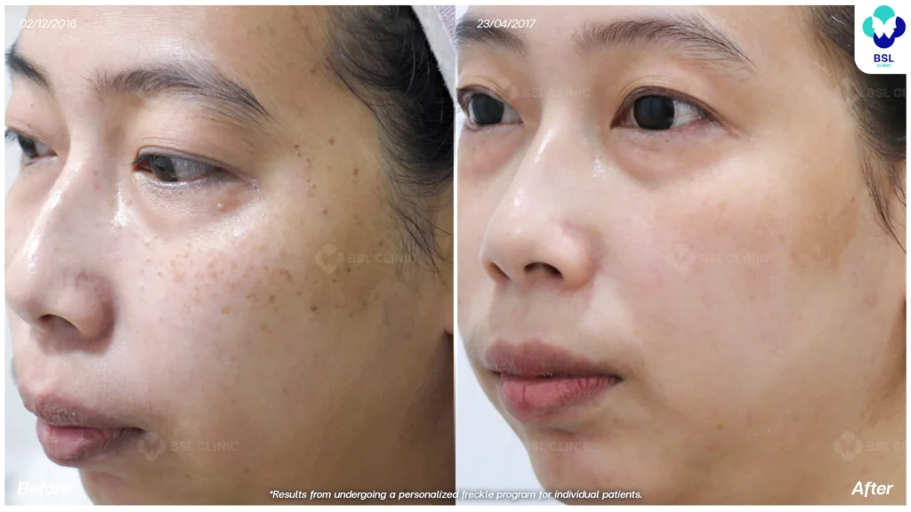 รีวิวรักษากระ