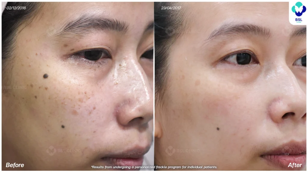 รีวิวรักษากระ