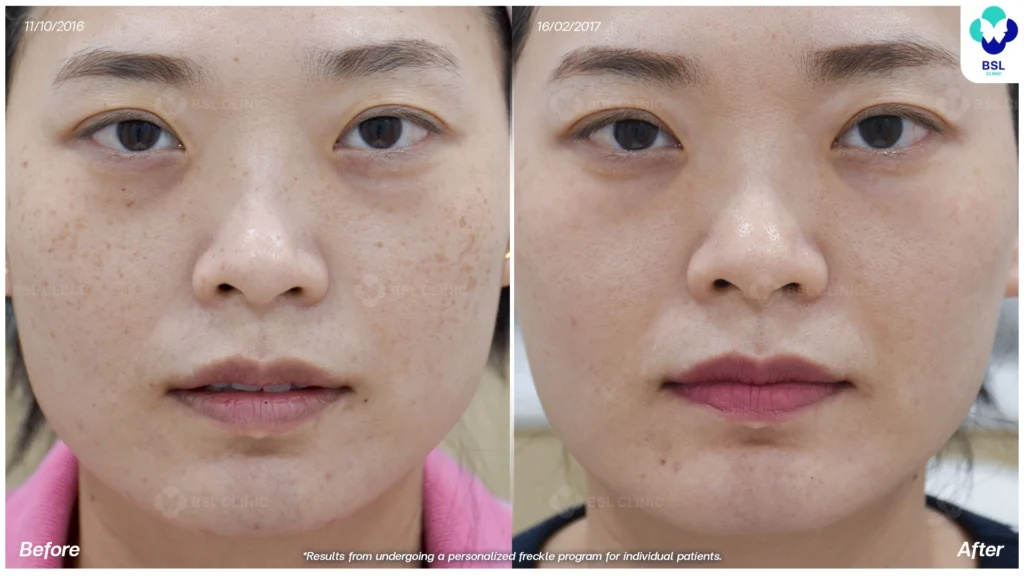 รีวิวรักษากระ