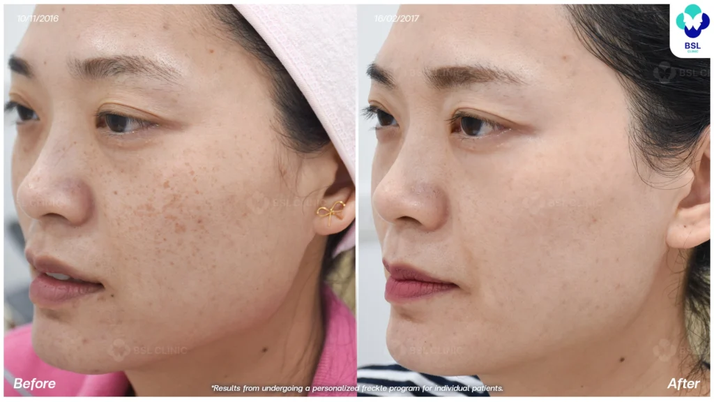 รีวิวรักษากระ