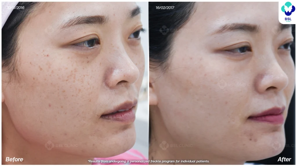 รีวิวรักษากระ