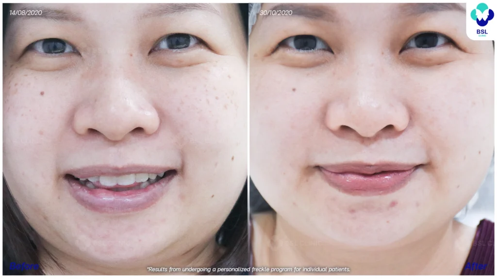 รีวิวรักษากระ