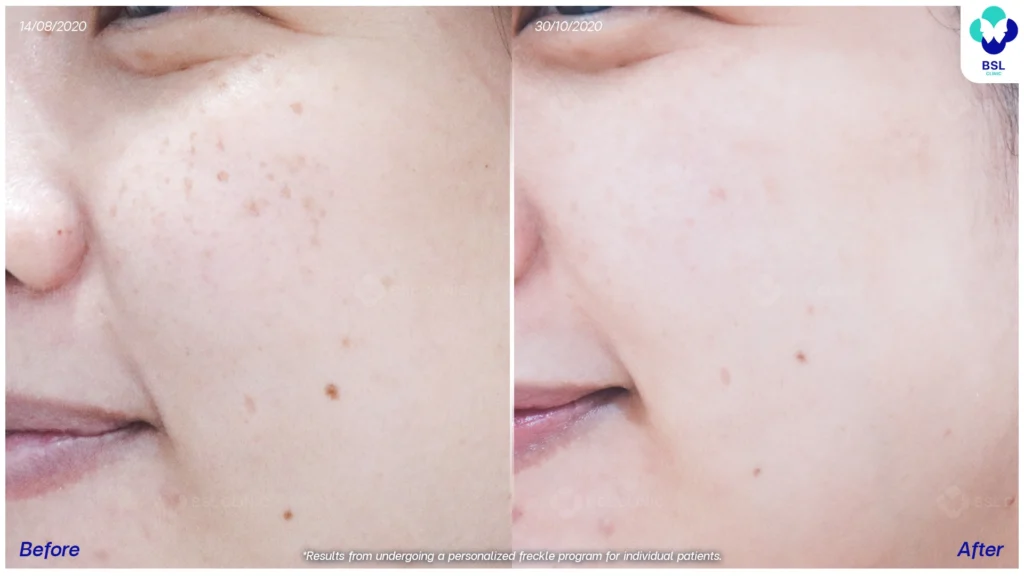 รีวิวรักษากระ