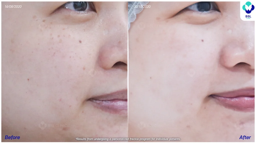 รีวิวรักษากระ