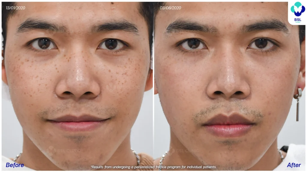 รีวิวรักษากระ