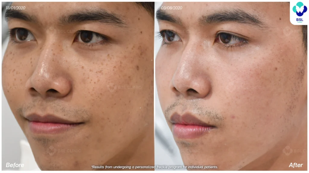 รีวิวรักษากระ