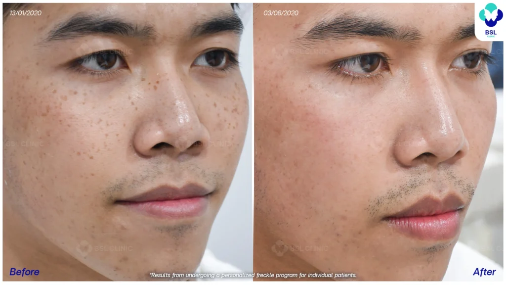 รีวิวรักษากระ