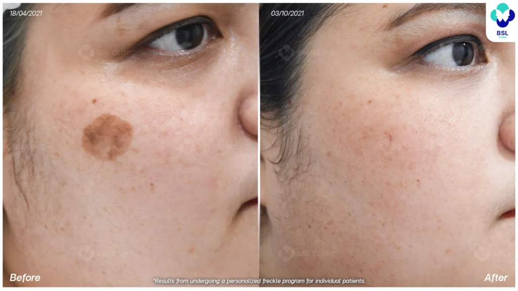 รีวิวรักษากระ