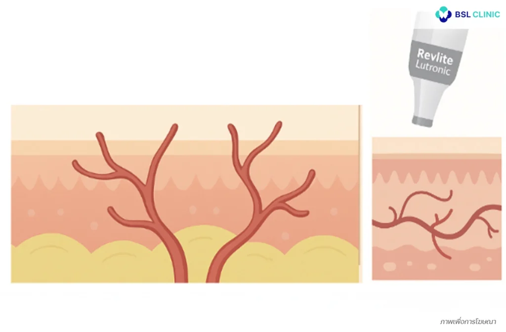 กระตุ้นการหดตัวของหลอดเลือดฝอย