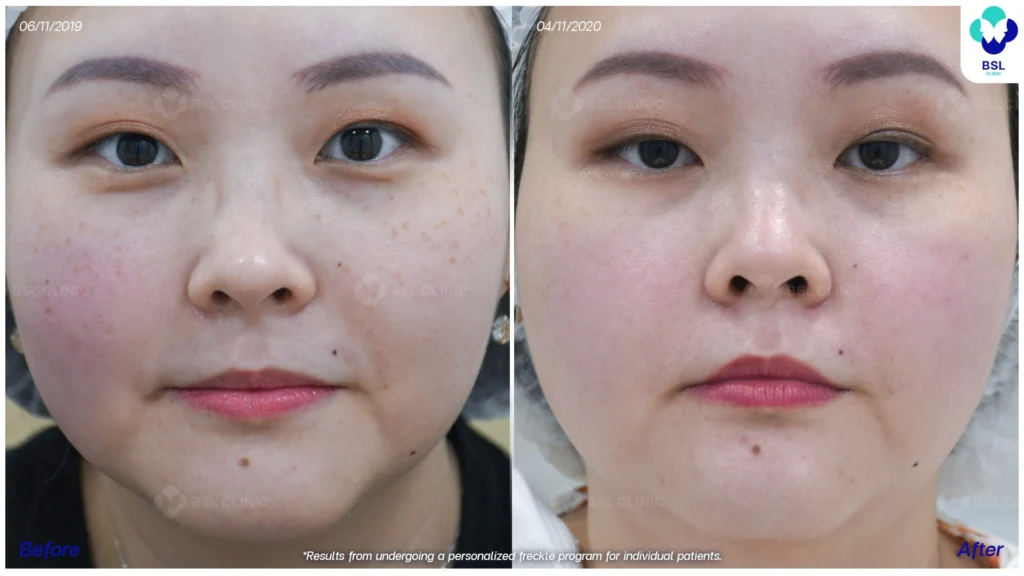 รีวิวรักษากระ