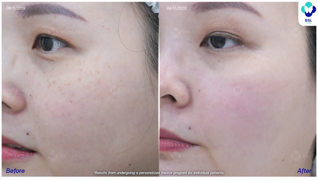 รีวิวรักษากระ