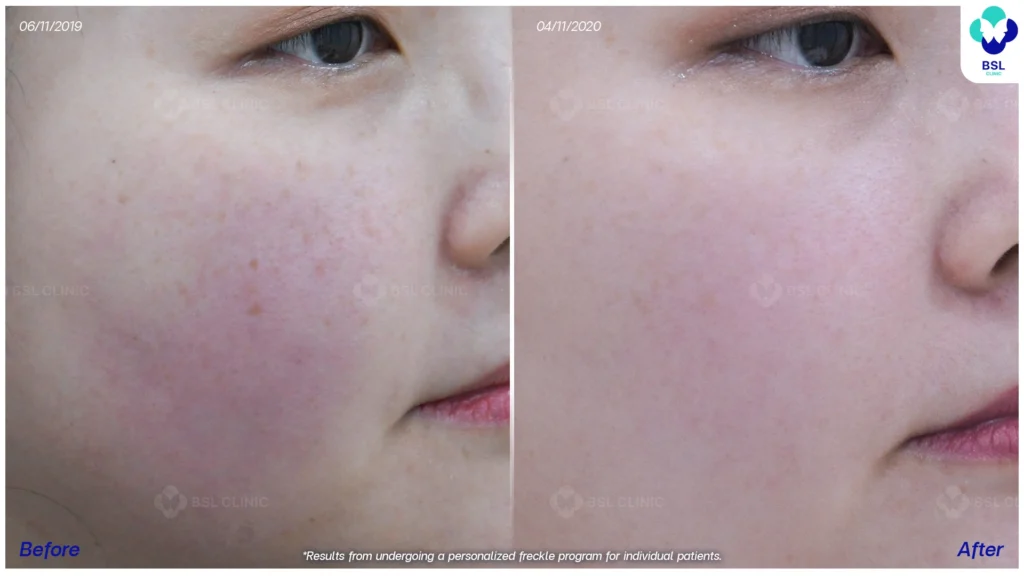 รีวิวรักษากระ