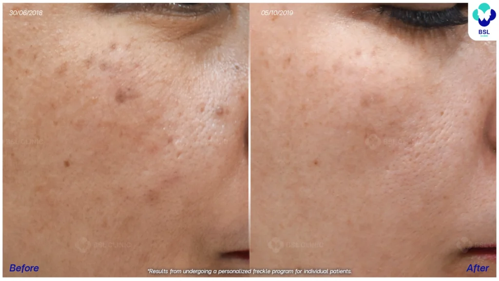 รีวิวรักษากระ