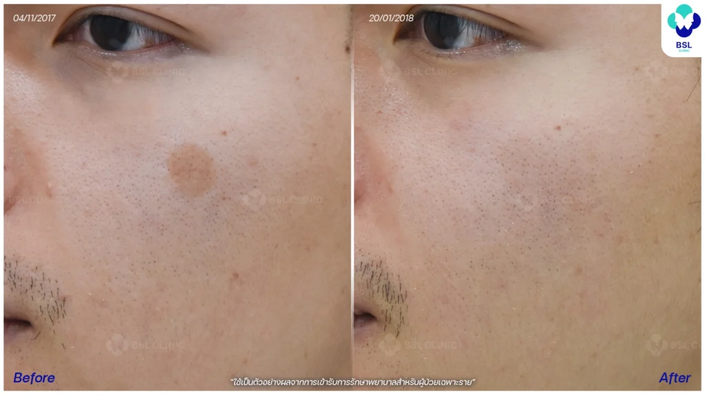 รีวิวรักษากระ