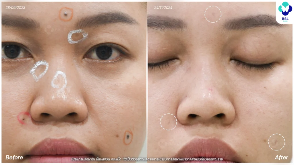 รักษา ขี้แมลงวัน ไฝ กระเนื้อ