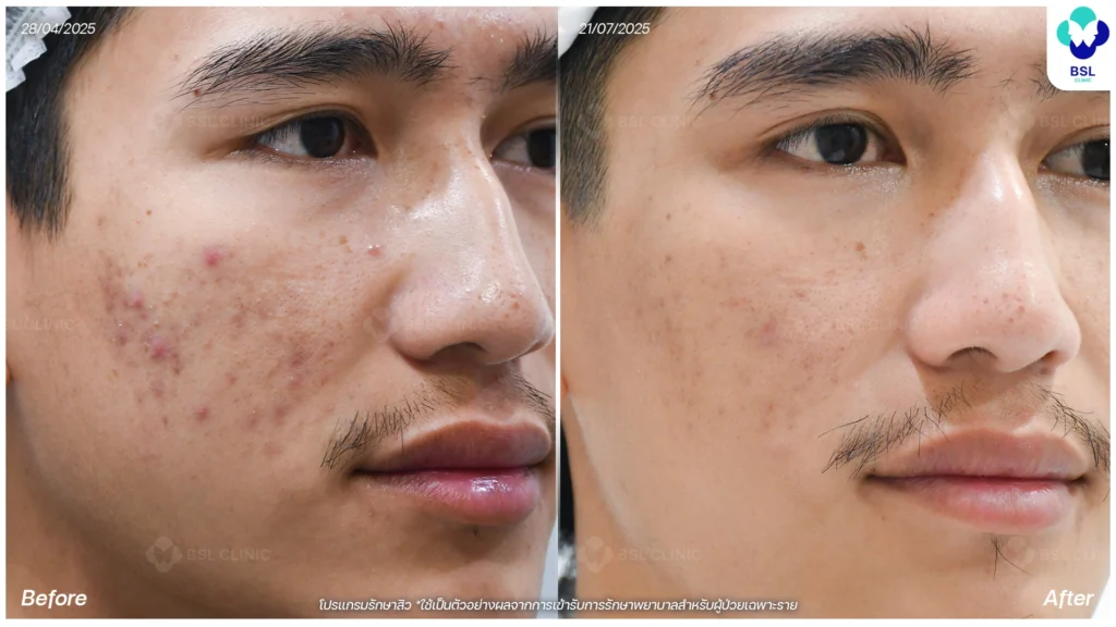 รีวิวรักษาสิว หนุ่มใต้