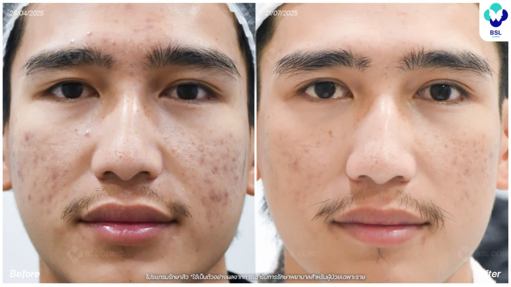 รีวิวรักษาสิว หนุ่มใต้