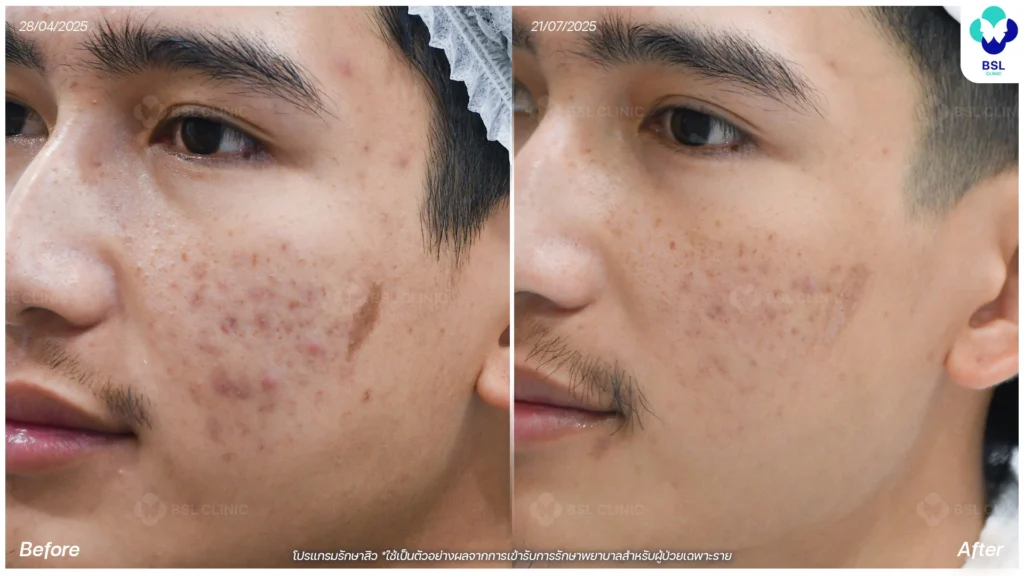 รีวิวรักษาสิว หนุ่มใต้