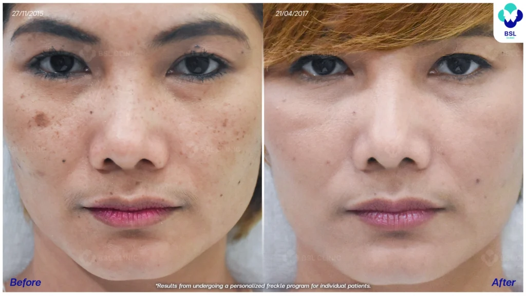 รีวิวรักษากระ