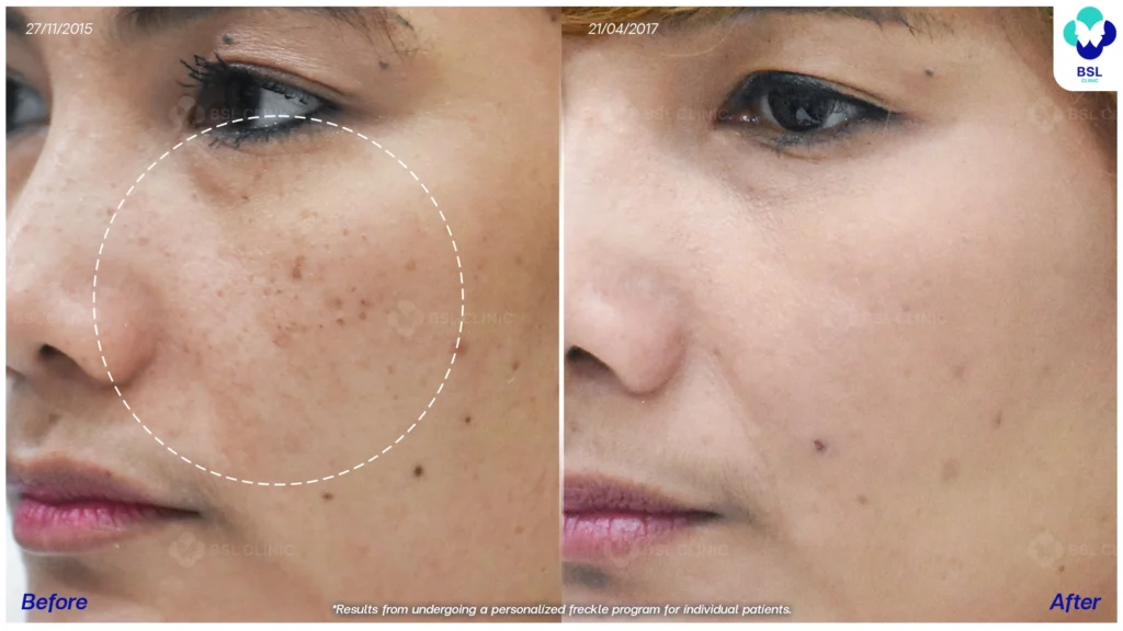 รีวิวรักษากระ