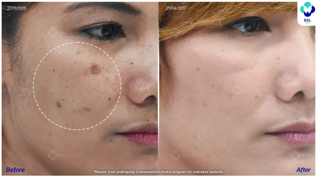 รีวิวรักษากระ