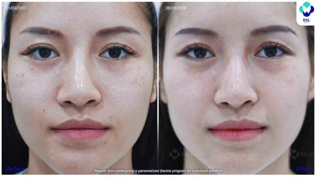 รีวิวรักษากระ