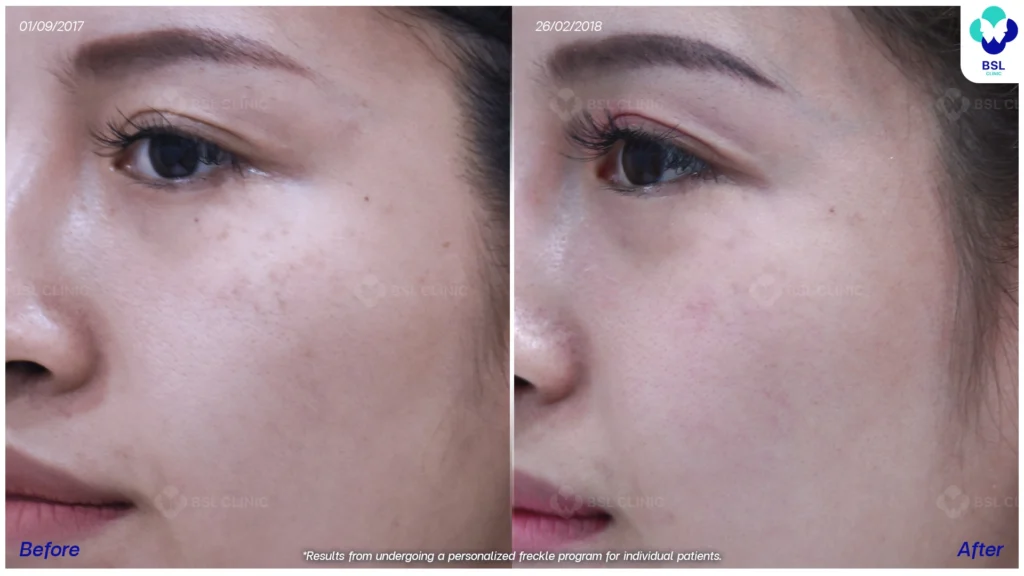 รีวิวรักษากระ