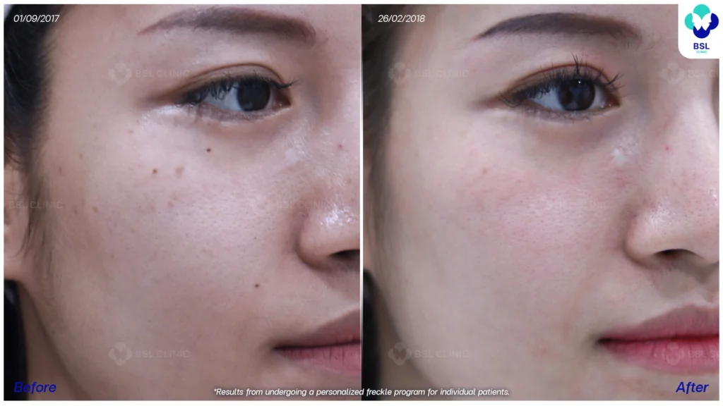 รีวิวรักษากระ