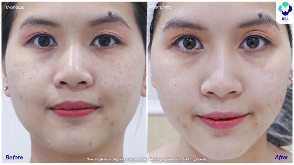 รีวิวรักษากระ