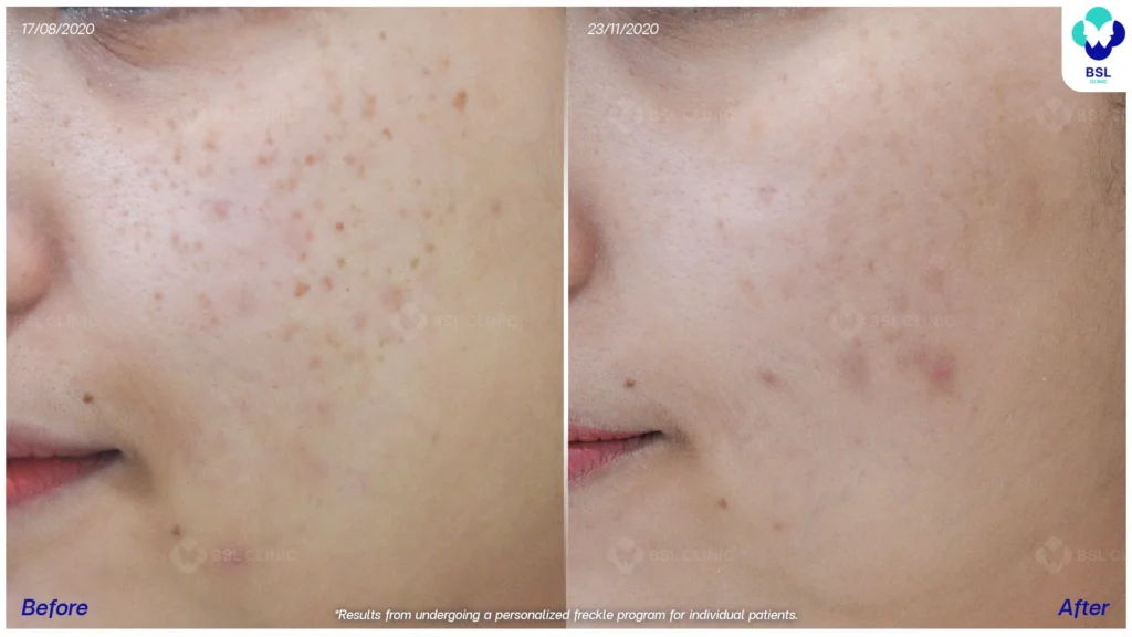 รีวิวรักษากระ