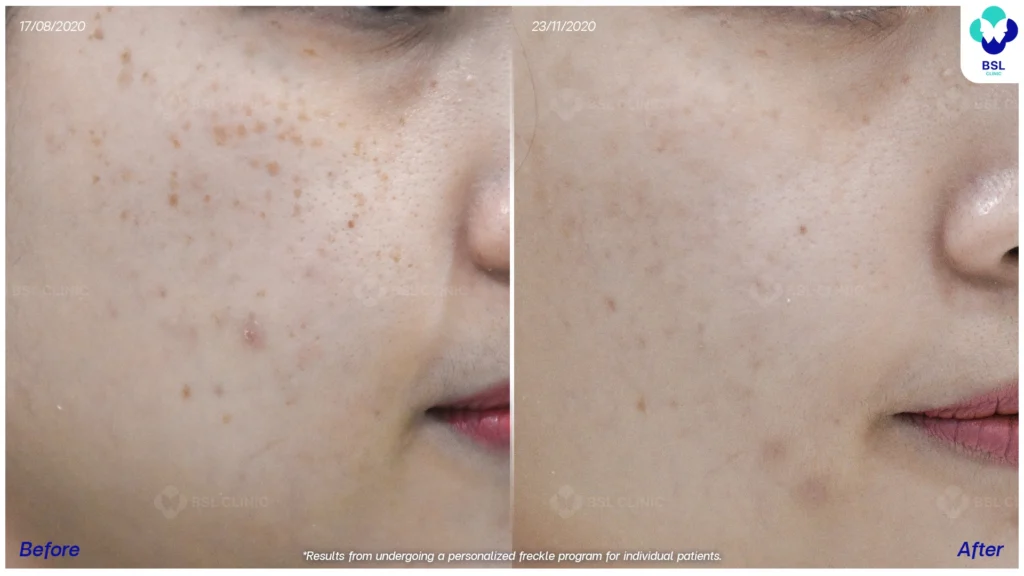 รีวิวรักษากระ