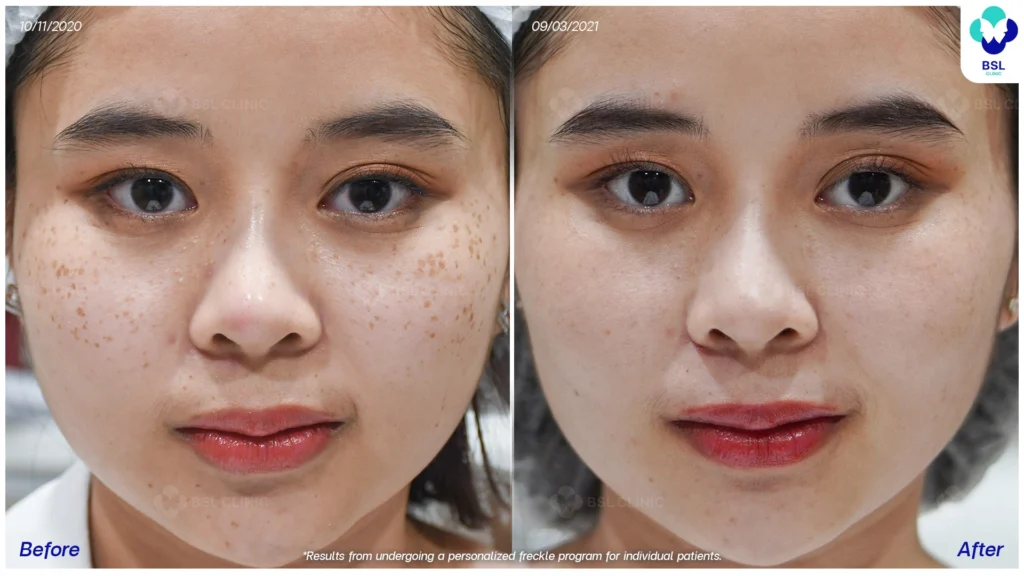 รีวิวรักษากระ