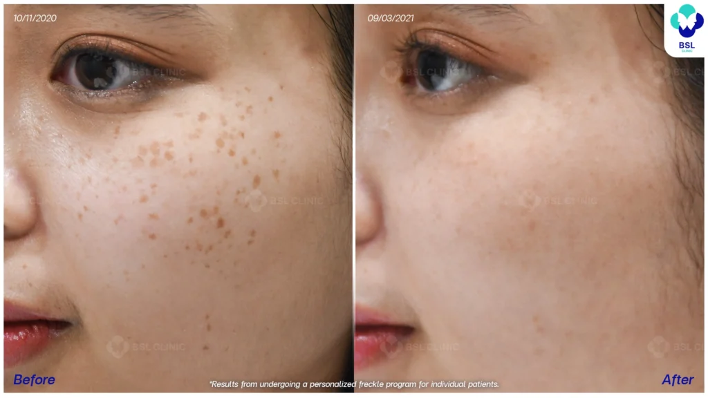 รีวิวรักษากระ