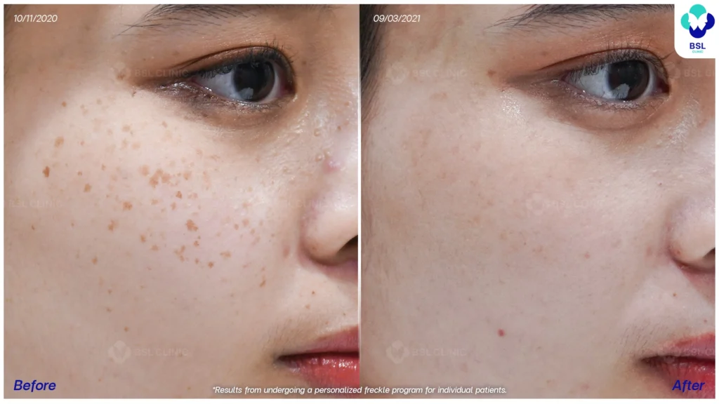 รีวิวรักษากระ