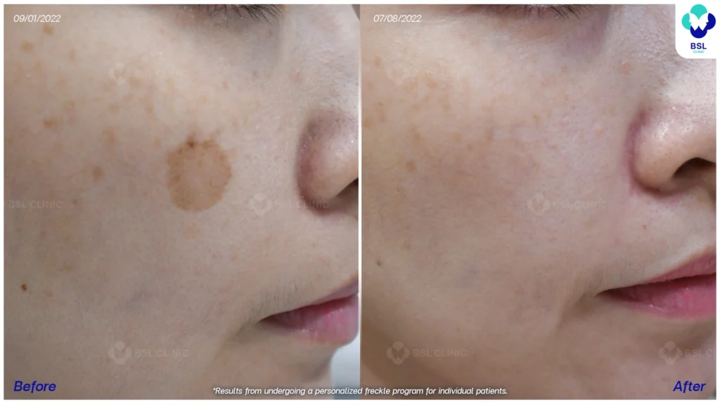 รีวิวรักษากระ