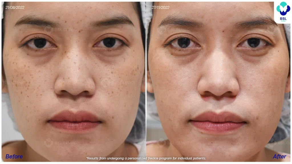 รีวิวรักษากระ